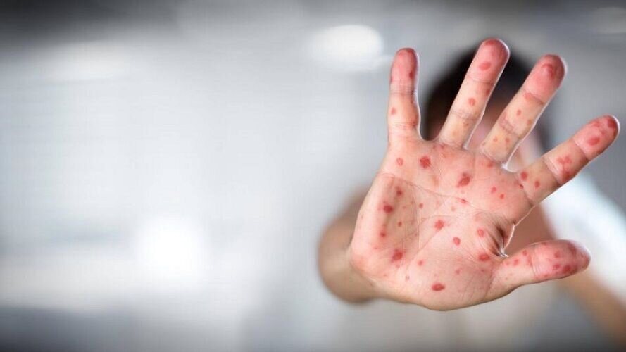 تصویر دلهرهآور از ورود آبله میمونی به ایران تصویر دلهرهآور از ورود آبله میمونی به ایران