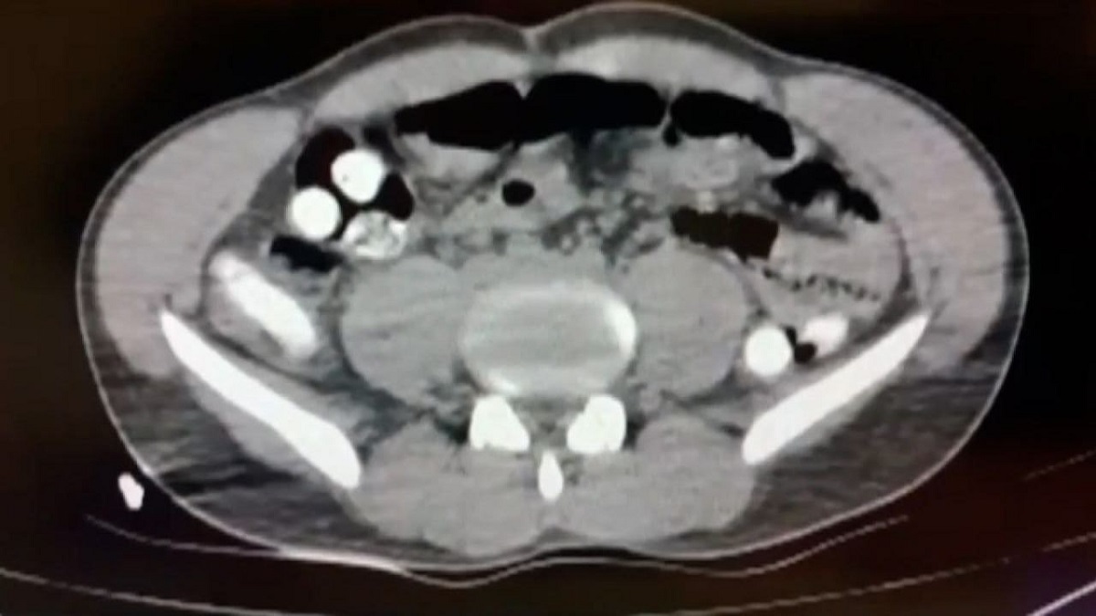 مسافر ایرانی با یک کیلو تریاک در معده به دام پلیس ترکیه افتاد (+عکس)