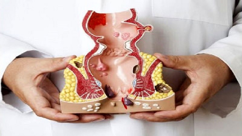 سیر تا پیاز بواسیر سیر تا پیاز بواسیر