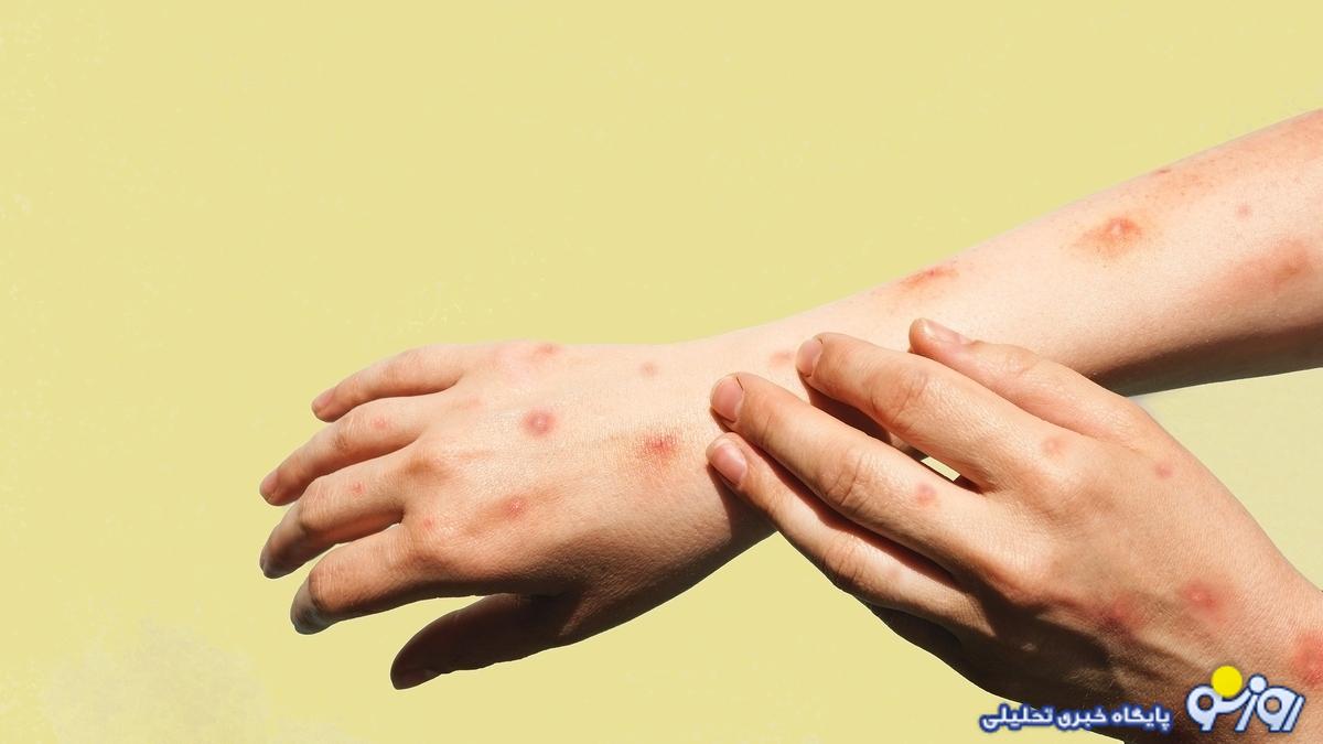 آبله میمونی چگونه منتقل میشود؟ آبله میمونی چگونه منتقل میشود؟