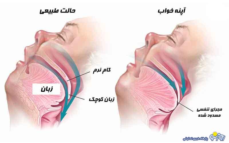 آپنه خواب چیست؟ آپنه خواب چیست؟