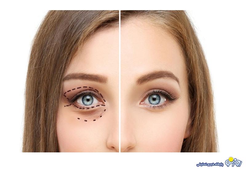 بلفاروپلاستی؛ تصمیمی هوشمندانه برای ارتقای ظاهر و کیفیت بینایی بلفاروپلاستی؛ تصمیمی هوشمندانه برای ارتقای ظاهر و کیفیت بینایی